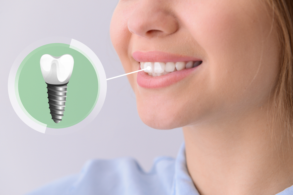 When To Replace a Broken Tooth With An Implant